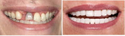 Dental Implants before and after photo
