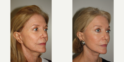 Facelift before and after photo