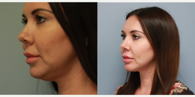 Kybella before and after photo