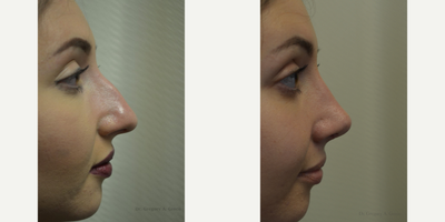 Rhinoplasty before and after photo