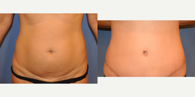 Tummy Tuck before and after photo