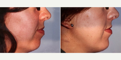 Chin Implant before and after photo
