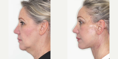Deep Plane Facelift before and after photo