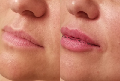 Dermal Fillers before and after photo
