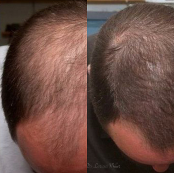 Hair Loss Treatment before and after photo