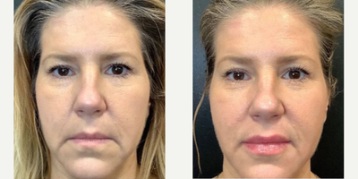 Lip Fillers before and after photo