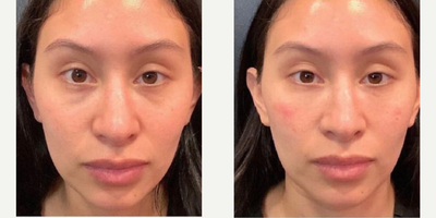 Dermal Fillers before and after photo