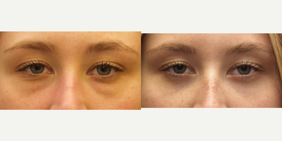 Eyelid Surgery before and after photo