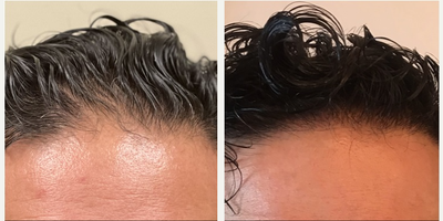 Hair Transplant before and after photo