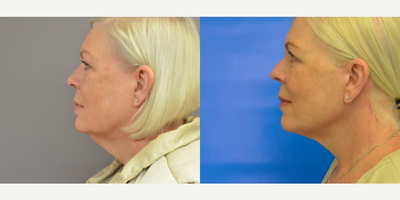 Lower Facelift before and after photo