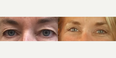 Eyelid Surgery before and after photo