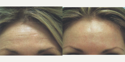 Botox before and after photo