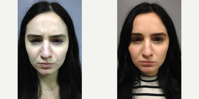 Botox before and after photo