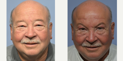 Brow Lift before and after photo