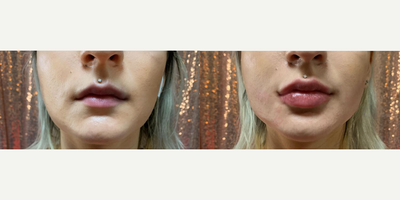 Chin Filler before and after photo