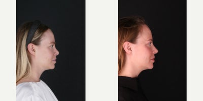 Revision Rhinoplasty before and after photo