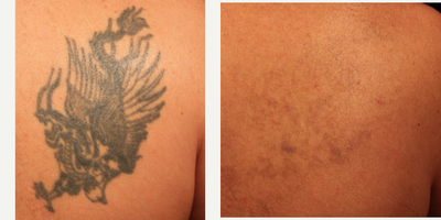Tattoo Removal before and after photo