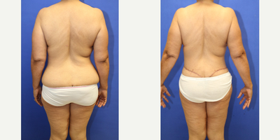 Body Lift before and after photo