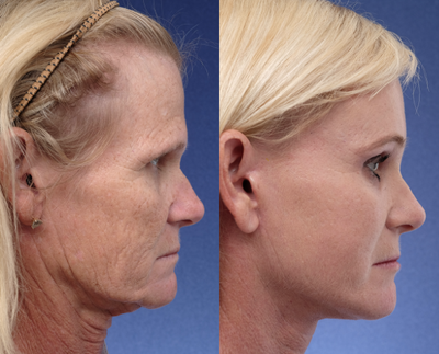 Brow Lift before and after photo