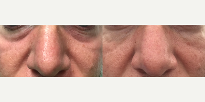 Eyelid Surgery before and after photo