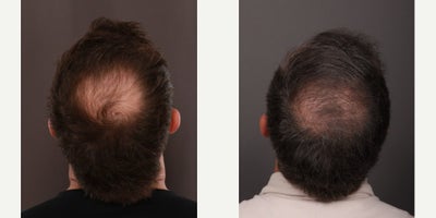 Hair Transplant before and after photo
