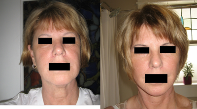 Mini Facelift before and after photo
