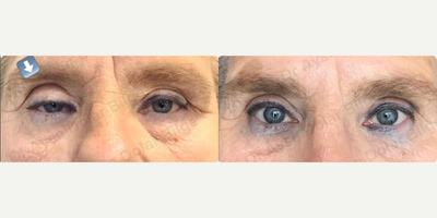 Ptosis Surgery before and after photo