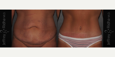 Tummy Tuck before and after photo