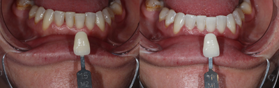 Zoom Whitening before and after photo
