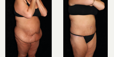 Body Lift before and after photo