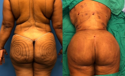 Butt Augmentation before and after photo