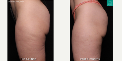 Cellfina before and after photo