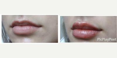 Lip Fillers before and after photo