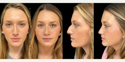 Rhinoplasty before and after photo