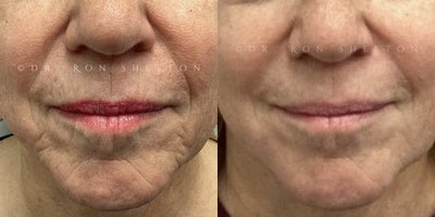 Dermal Fillers before and after photo