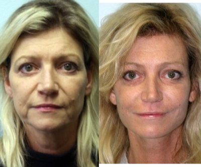 Facelift before and after photo