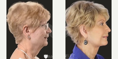 Facelift before and after photo
