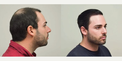 FUE Hair Transplant before and after photo