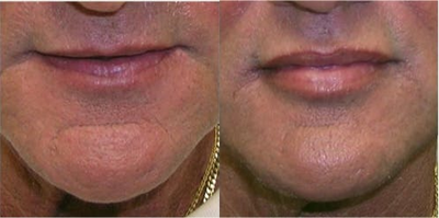 Juvederm before and after photo