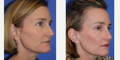 Rhinoplasty before and after photo