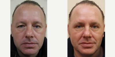 Eyelid Surgery before and after photo