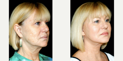 Facelift before and after photo