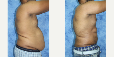 Liposuction before and after photo
