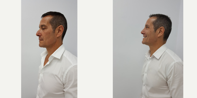 Rhinoplasty before and after photo