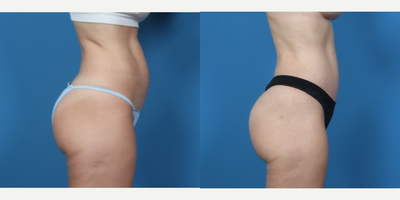 Tummy Tuck before and after photo