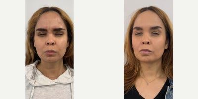 Dysport before and after photo