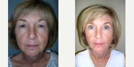 Facelift before and after photo