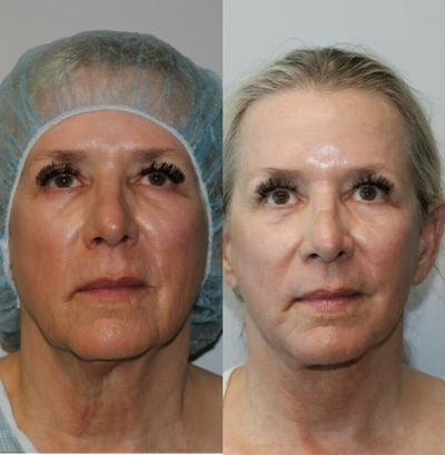 Facelift before and after photo
