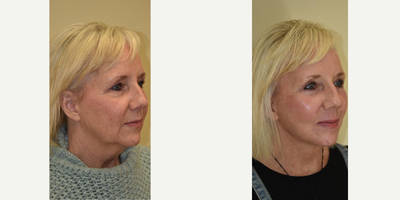 Laser Resurfacing before and after photo
