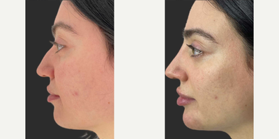 Nonsurgical Nose Job before and after photo